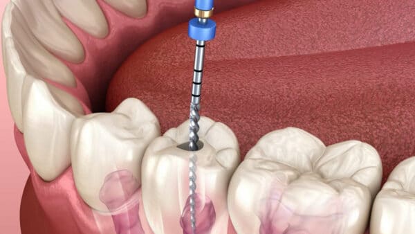 Root Canal Treatment in Pitampura at Dr. Mallick Dental Centre Root Canal Treatment: Pain-Free Solutions at Dr. Mallick’s Dental Centre, Pitampura