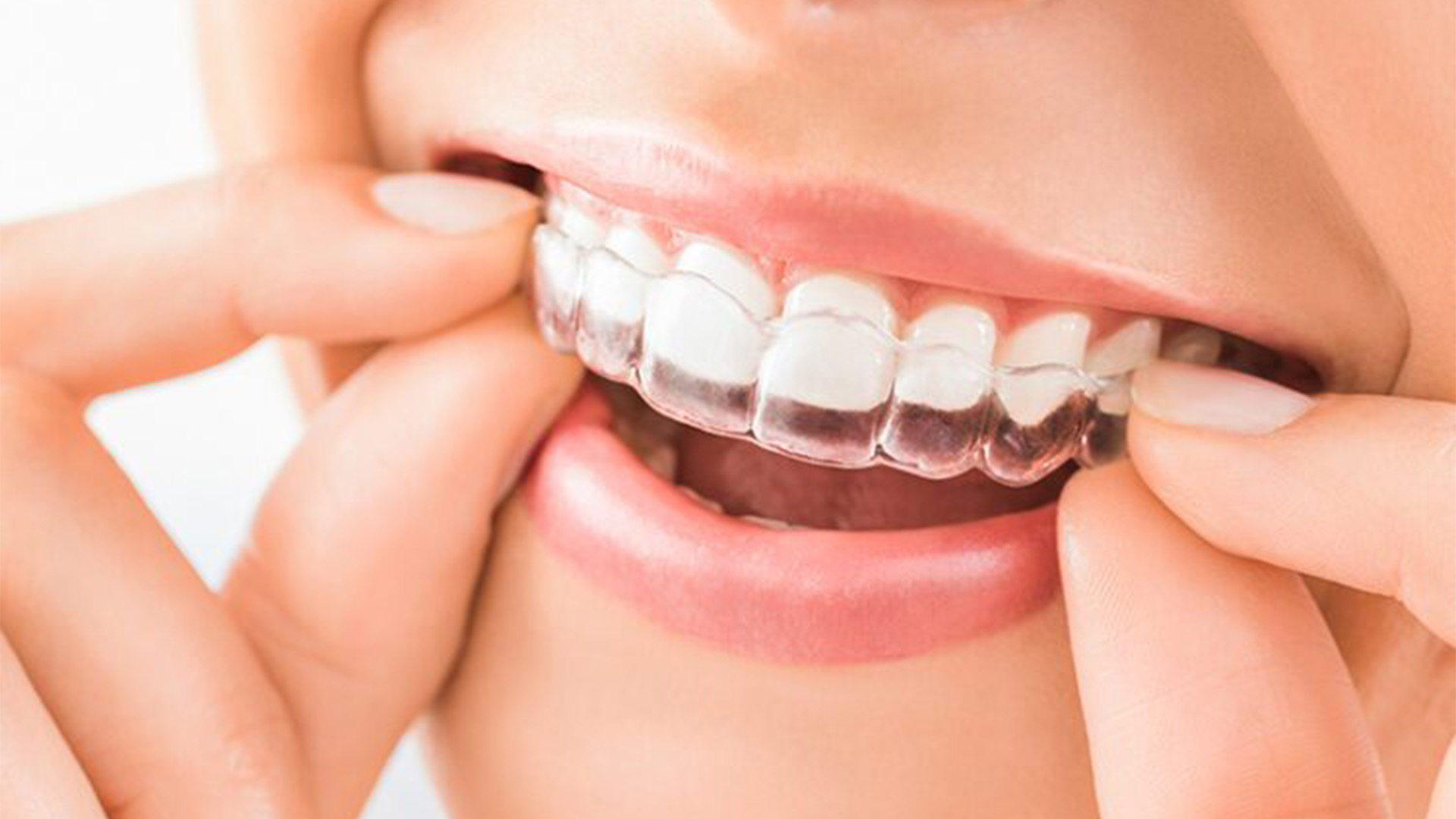 Achieve the Perfect Smile with Clear Aligners in Pitampura