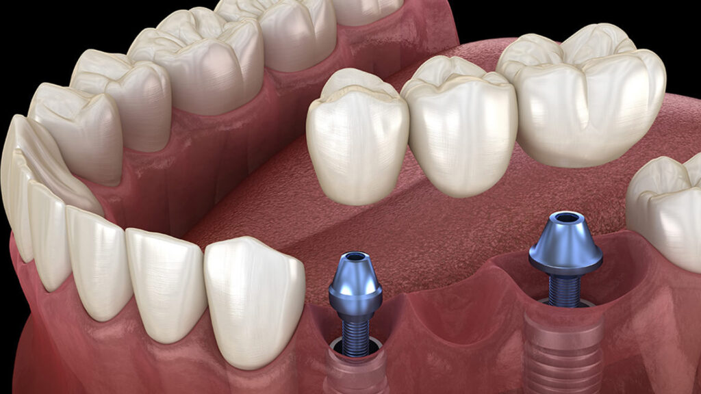 Dental Implants: The Permanent Solution for Missing Teeth in Pitampura