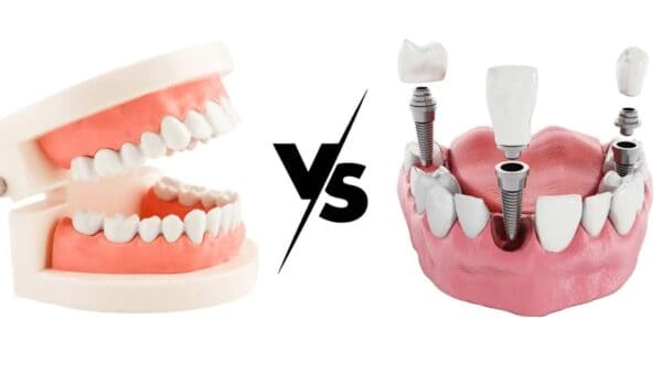Dental Implants vs. Dentures – What’s Best for You?