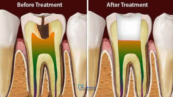 What to Expect During a Root Canal Treatment