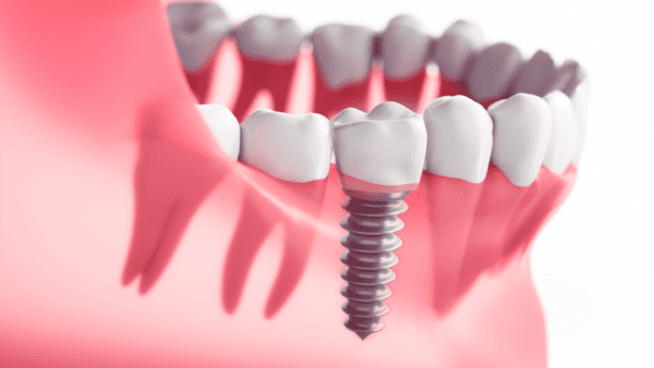 Dental Implant Aftercare – How to Make Your Implant Last a Lifetime