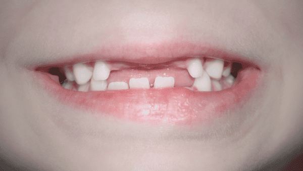 Why Children’s Milk Teeth Are Important – Early Dental Care in Pitampura