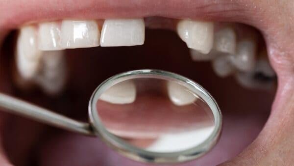 Missing Teeth Solutions in Pitampura – Implants, Bridges, or Dentures?