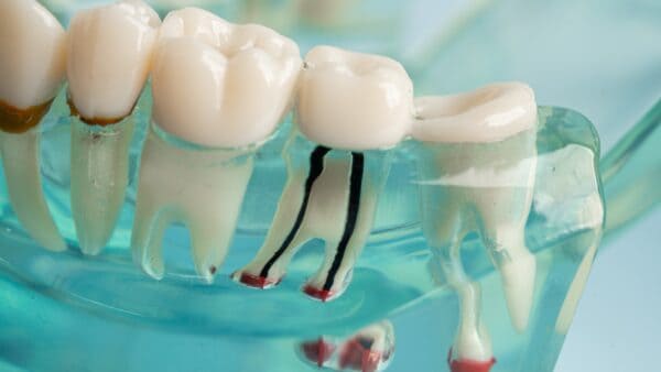 Root Canal Treatment in Pitampura – Save Your Natural Tooth