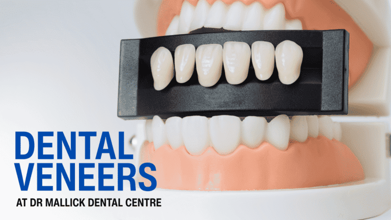 Dental Veneers in Pitampura – A Simple Way to Get a Flawless Smile