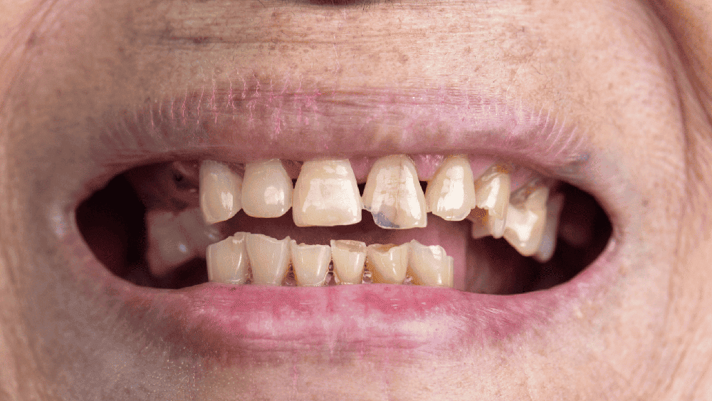 8 10 Daily Habits That Damage Your Teeth | Dentist in Pitampura