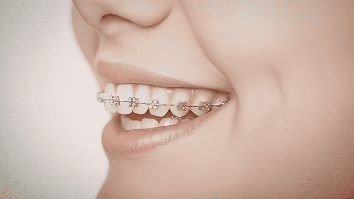 Dental Braces in Pitampura – Straighten Your Teeth for a Healthy Smile