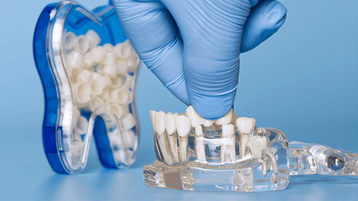 Dental Crowns in Pitampura – Restore Strength and Beauty to Your Teeth