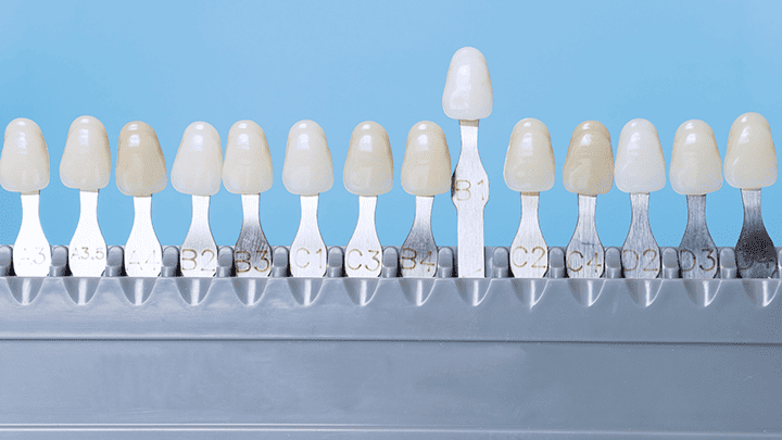 Dental Veneers in Pitampura – Transform Your Smile with Natural-Looking Veneers