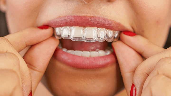 Invisalign Aligners in Pitampura Clear Aligners Treatment – Dr. Mallick Dental Centre