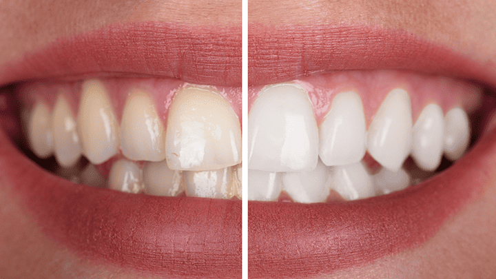 Teeth Whitening – Myths vs Facts