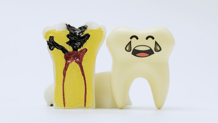 Tooth Decay Treatment in Pitampura – Protect Your Teeth from Cavities