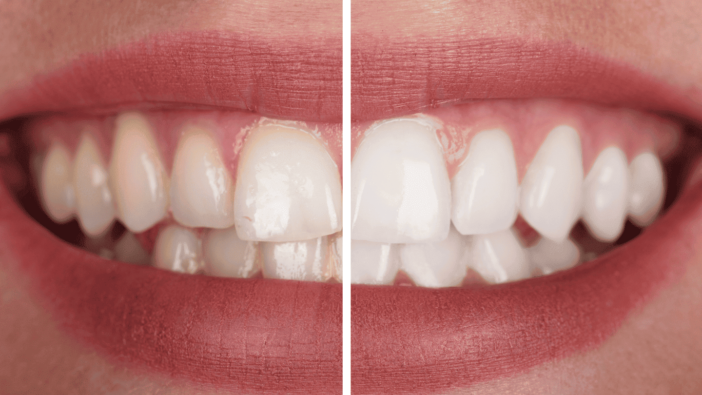 Teeth Whitening in Pitampura, Cosmetic Dentistry & Wisdom Tooth Removal – Complete Smile Care Guide