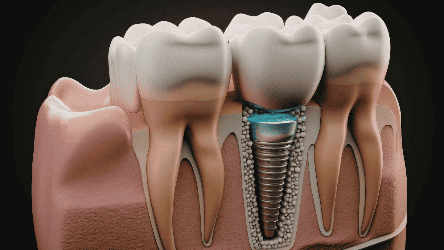 Dental Implants in Pitampura – The Best Permanent Solution for Missing Teeth